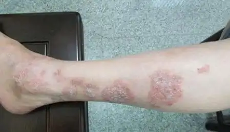 广州腿上出现白色的癣块是不是银屑病_广州肤康银屑病医院