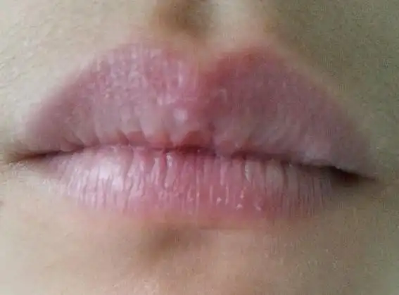 嘴唇上一直长白色的点不痛不痒用手可以