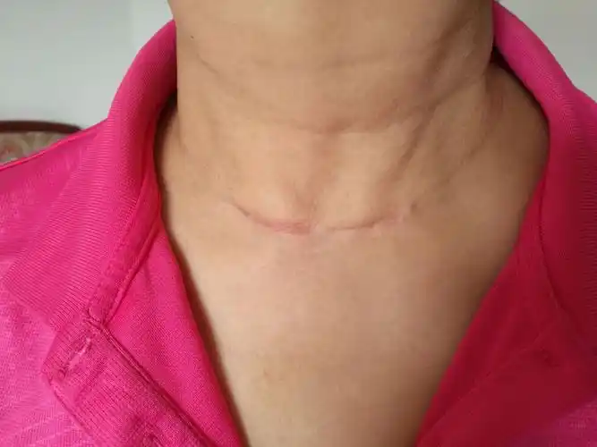 2017年9月4日这是手术半年了照的伤口愈合情况,还是有点肿,没有完全