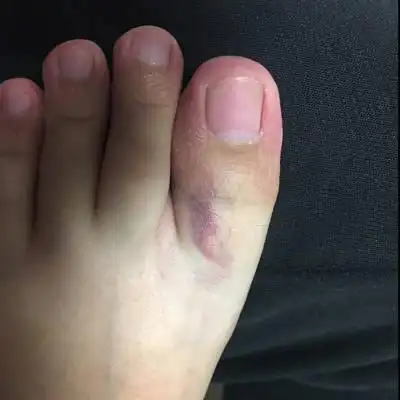 大脚趾头突然出现红紫色,过了两天变小但是位置变了,有没有人遇到过?