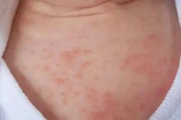 宝宝长痱子用什么擦效果好宝宝长痱子怎么快速消除止痒