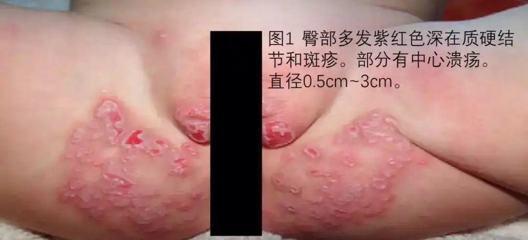 病例讨论 第144期丨1岁宝宝"尿布疹"为什么这么严重?