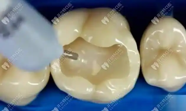 看完意大利美塑树脂的优缺点不管其价格是多少一颗就回本