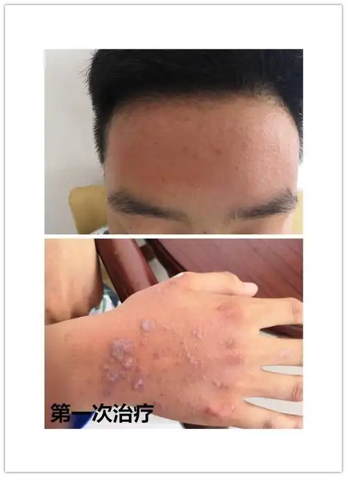 艾拉光动力治疗扁平疣正是利用了它的这一特点,将光敏剂盐酸氨酮