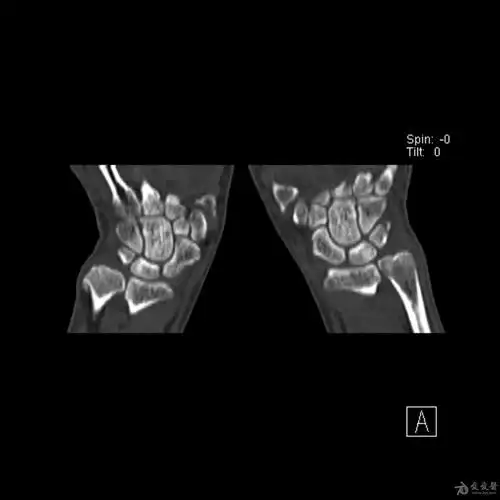 腕部三角骨骨折