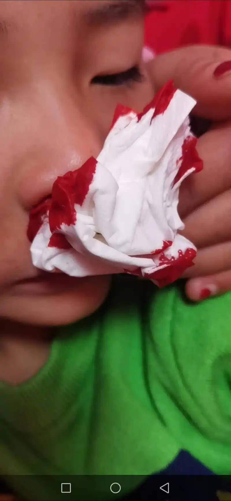 谁能知道流鼻血怎么治除根.看到我 - 抖音