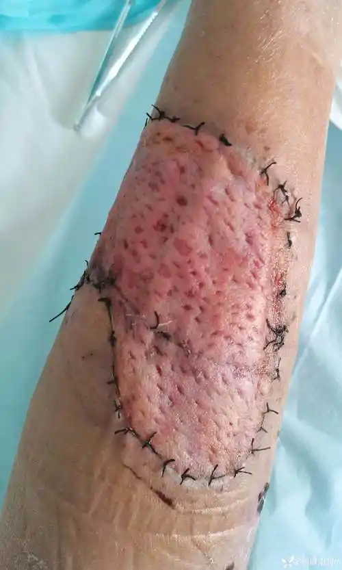 小腿后侧组织缺损vsd辅助游离植皮