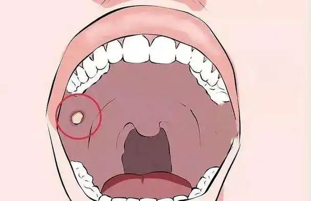 广药三院肿瘤一科丨上颚发现一粒"黄豆",他住院了_手机搜狐网