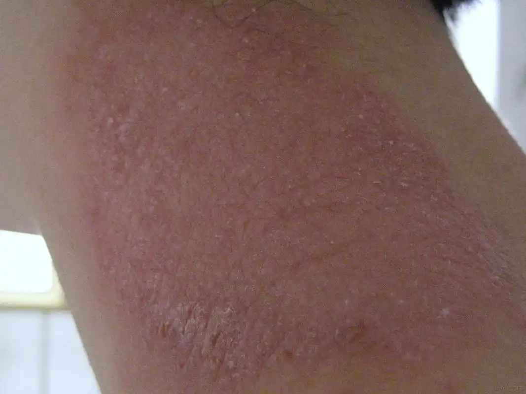 这位患者,脖子上皮肤很痒,以为是癣,涂抹了达克宁