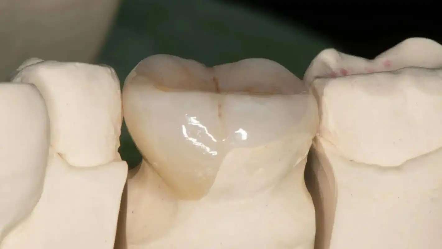 顾客不良充填牙折裂微创嵌体修复病例: 图1-2,不良充填和牙 - 抖音