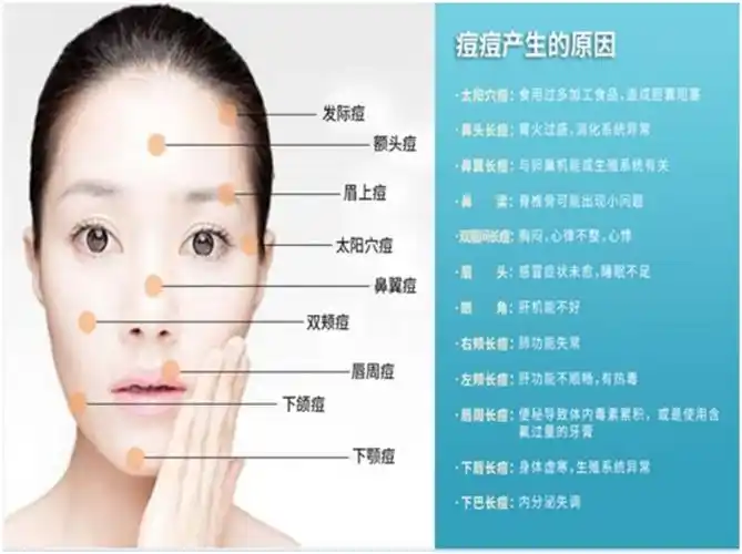 写美篇这张图向我们展示了痘痘长在脸部什么位置,是代表了身体的一些