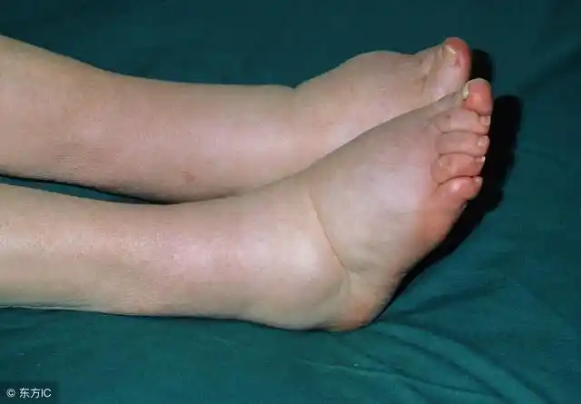 受够了满月脸水牛背怎么减弱激素的副作用