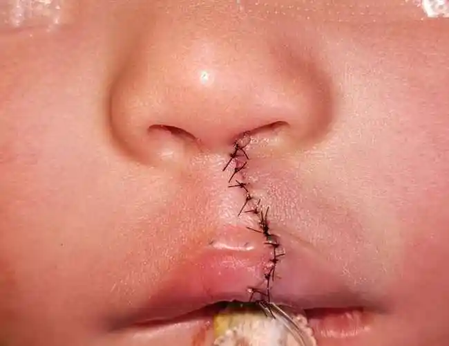 单侧唇裂的最佳治疗年龄在3个月以上,体重7公斤左右;双侧唇裂在6个月