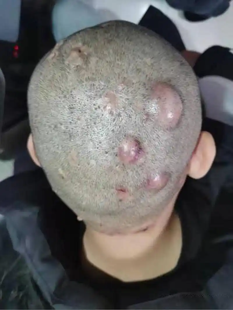 今天发来复诊照片的一位毛囊炎患者,男22岁,大学生.