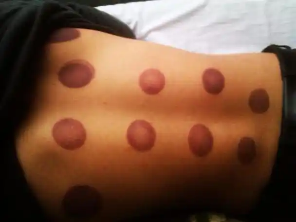 拔火罐时后背吸出来的瘀血是体内的毒素吗或许和你想得不一样