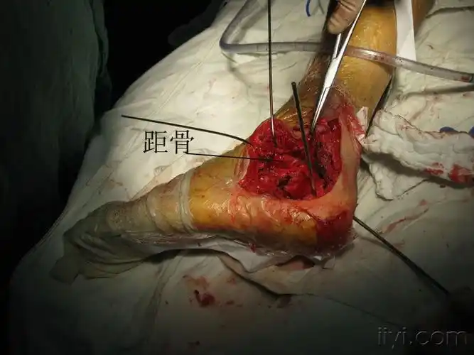 左跟骨粉碎骨折切复一例请点评 - 骨科与显微外科专业讨论版 - 爱爱医