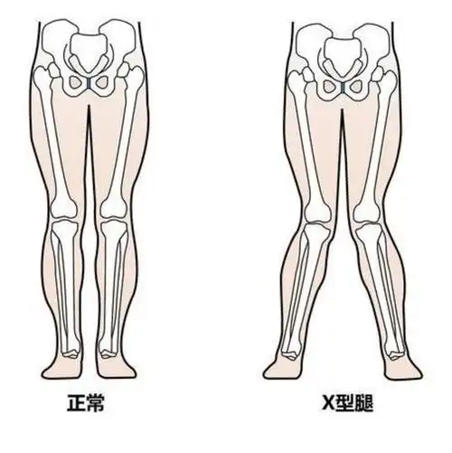 小孩8岁还是x型腿,该如何有效纠正?