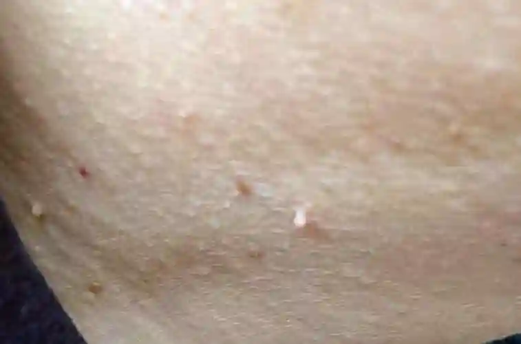 脖子和腋下长出的小肉粒,没有特别的感觉,不疼也不痒,但是长时间都不