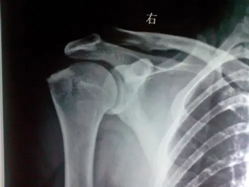 一张肩关节的片子