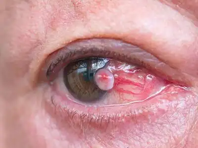 角膜鳞状上皮细胞癌的症状和图片 - 有来医生