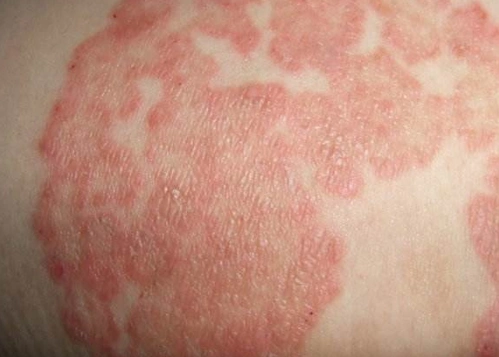 异位性皮炎有哪些症状 异位性皮炎形成的原因