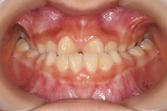 儿童地包天与哪些因素有关