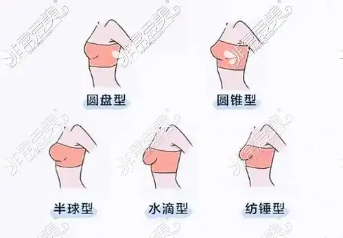 正常胸型和外扩的区别是什么,看后就懂怎么判断