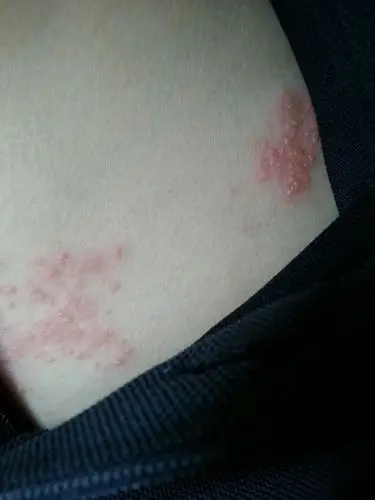 身上又水泡一样的包! 这是什么病啊 !急急急!