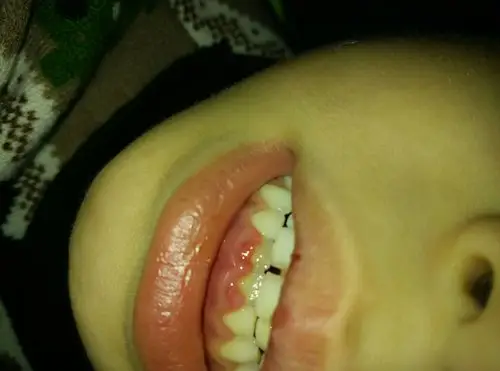 男孩8岁,牙龈肿,还有脓水,嘴唇舌头上还有溃疡,怎么回事?