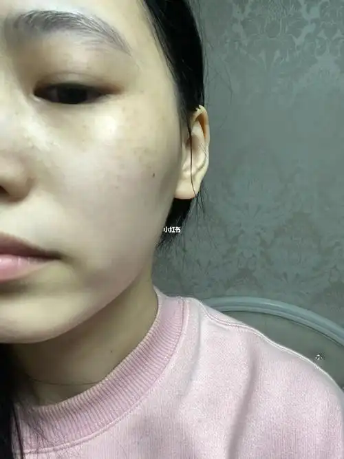 记录晒斑淡化的第十二天