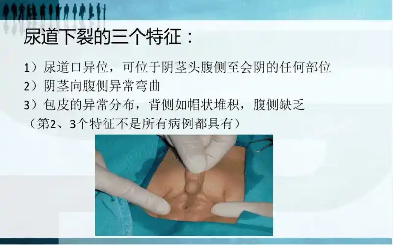 尿道下裂常用术式pptppt