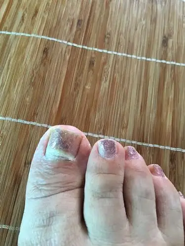 指甲有白色斑块,越来越大了,请问大家是怎么回事?谢谢