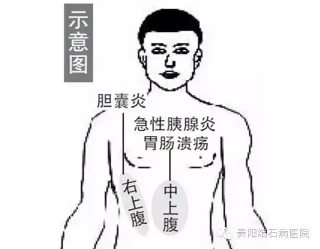 健康科普:谈谈常见病"胆囊炎"的二三事