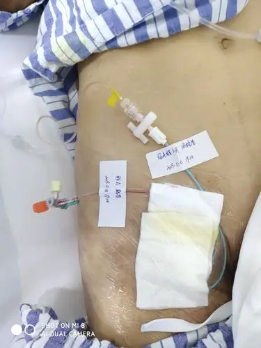 置管溶栓,给予冲击量肝素 尿激酶.后续持续泵入.