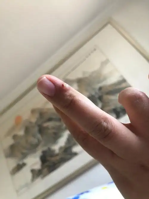 盐敷法下的孕期长的化脓性肉芽肿