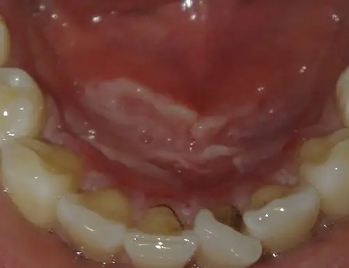 嘴里边被烫伤起泡泡了怎么办?