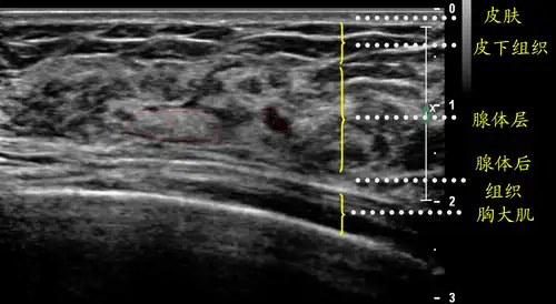 一张正常的乳腺b超图 - 超声医学讨论版 - 爱爱医医学论坛
