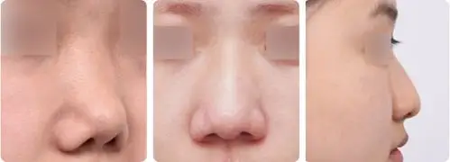 鼻翼肥厚看着笨拙又迟钝 鼻翼宽大看着土气不精致 鼻翼下垂加深法令纹