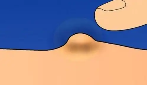 粉瘤会自己消失吗(粉瘤会自己消失吗是恶化了吗)_竞价网