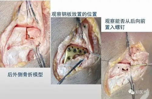 截骨|腓骨_网易订阅