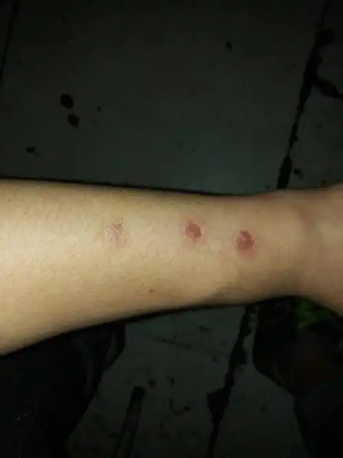 手上有烟疤可以当兵吗?