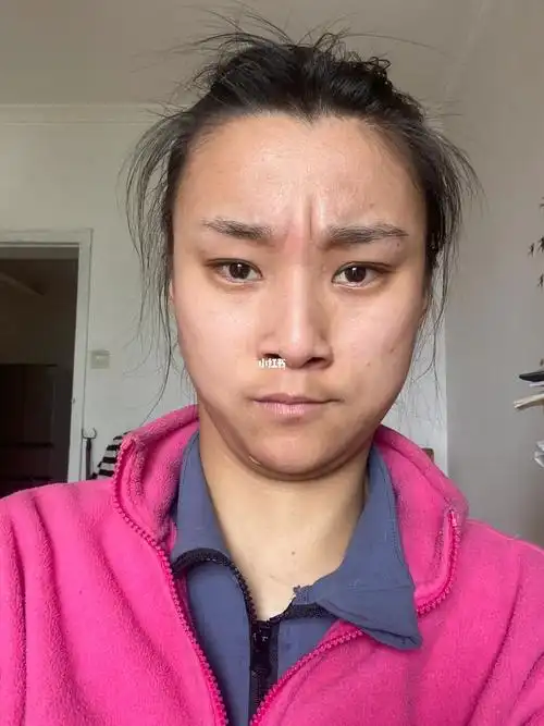 后天就要去搞我的川字纹了