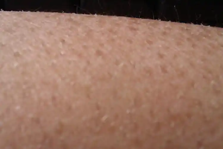 身上有好多皮屑,像鱼鳞一样,一搓就到处飞,皮肤佷干燥