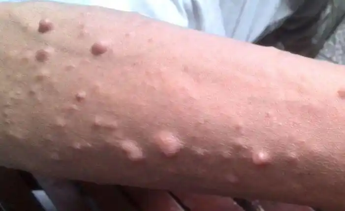 皮肤犹如"洒上牛奶咖啡",浑身长满瘤子,警惕这种极易被误诊的疾病