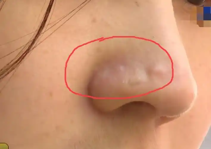 "我不想要这个鼻子了",女子花8万多整形,结果整出"幺蛾子"