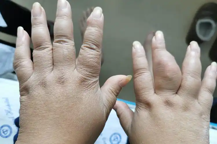 手指关节处的痛风石图