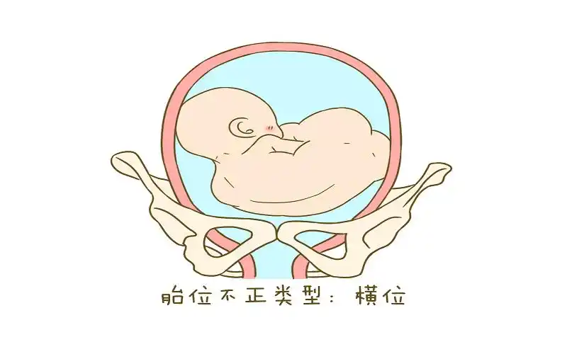 胎儿横位属于胎位不正