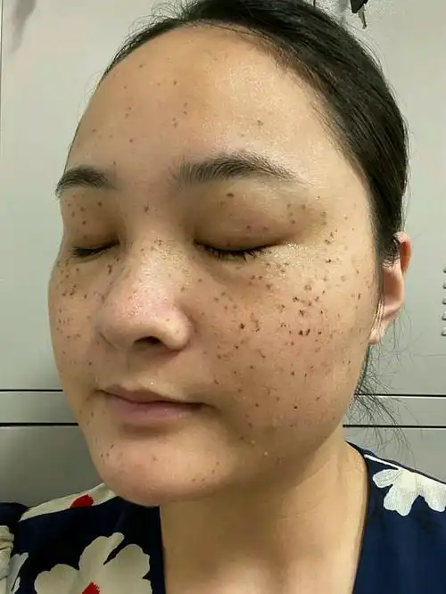 今天是超皮秒的第四天了,感觉跟第三天没有太大的变化_圈子-新氧美容