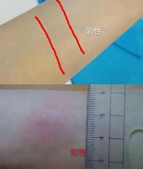 或hiv,aids)而导致免疫功能减弱 正常值 阴性:ppd皮试位置不发生红肿