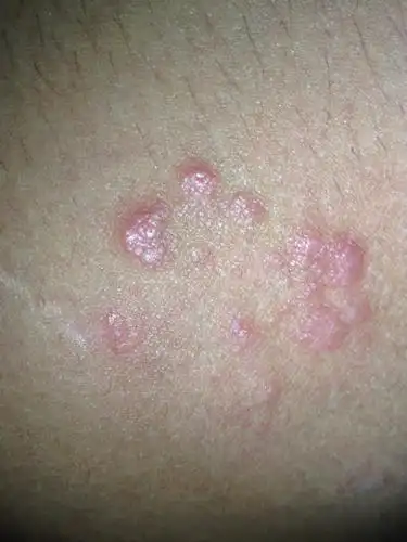 大腿内侧长了许多扁平疙瘩很痒有时候消